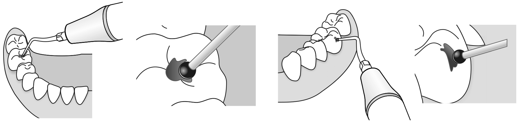 Сфера применения наконечника для скалера